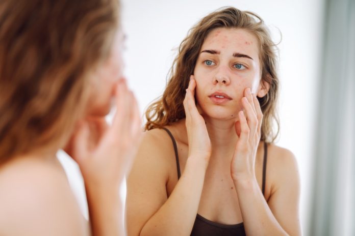 Skin,Problem.,A,Beautiful,Woman,Touches,Her,Inflammation,On,Her